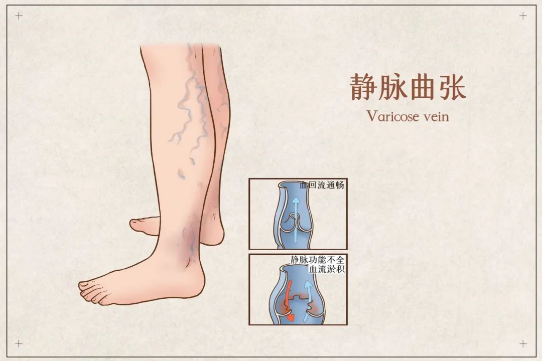 徐州中醫名松堂:腿上出現這條筋要小心,它是血管裡