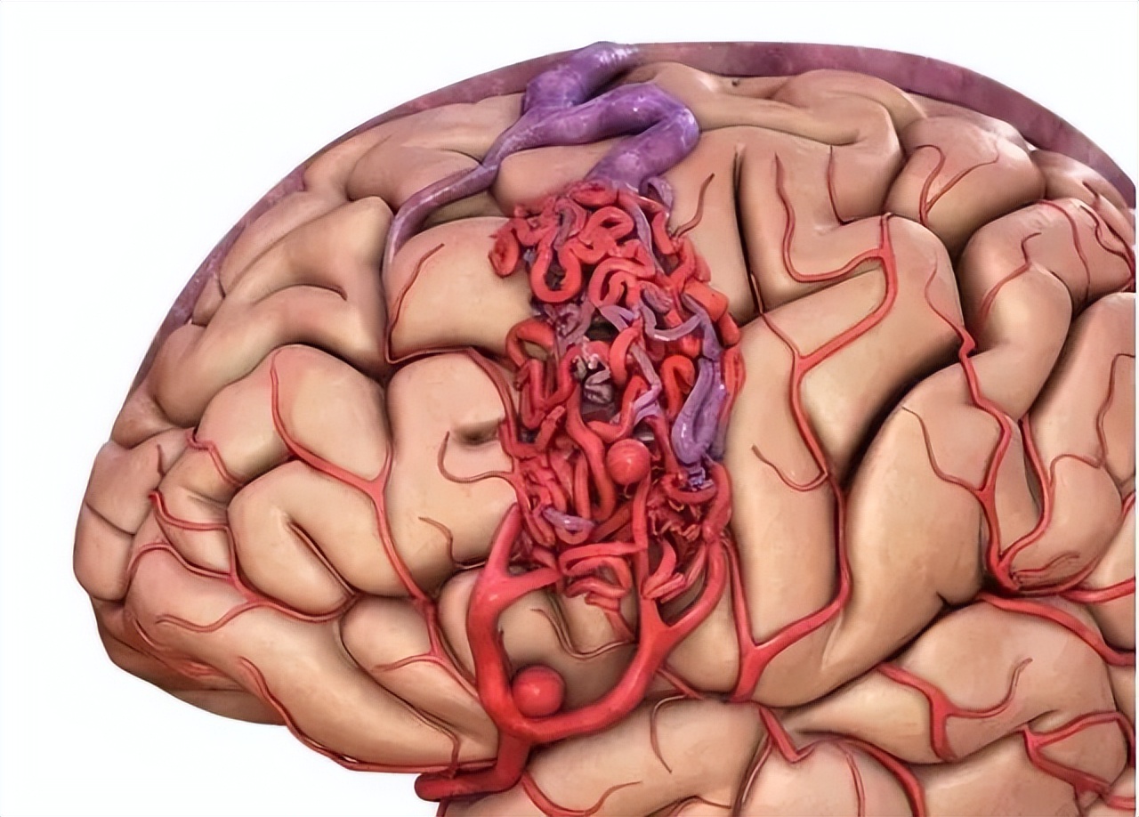 女子头痛5年,幸好体检揪出脑血管病及时止损,医生:常年头痛别大意