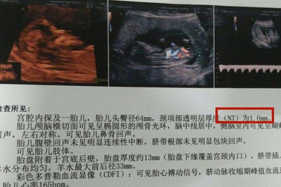 孕早期b超单上的这两个数据,暗示了胎儿小秘密,孕妈别忽略