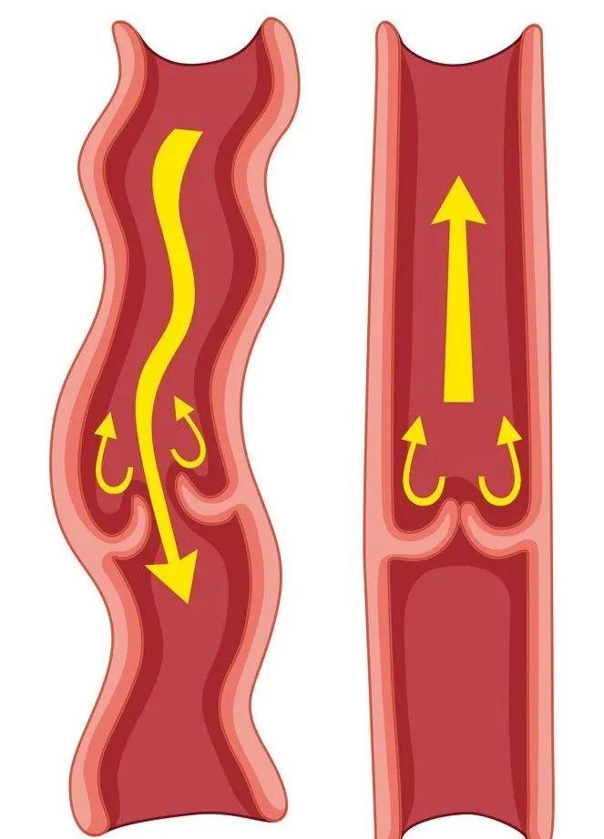 下肢静脉曲张卡通图片
