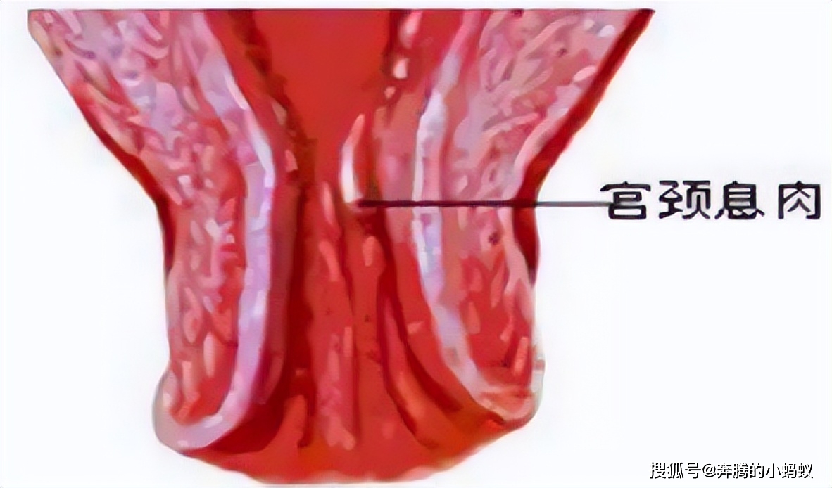 外阴赘生物是什么东西图片