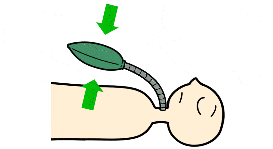 麻醉科医生ibsen建议对病人施行气管切开,采用麻醉用的球囊进行间断