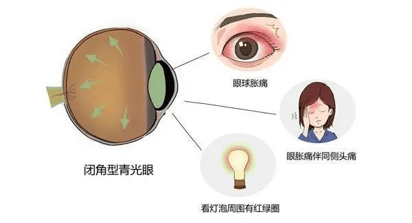 治疗的青光眼类型为急性闭角型青光眼,该类型青光眼起病急骤,症状严重