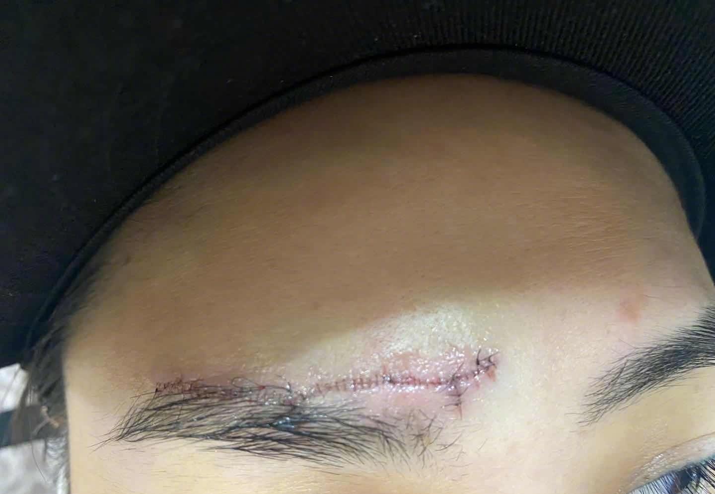 额际一道长伤疤似蜈蚣,带伤复工令人心疼_霍汶希_照片_内心