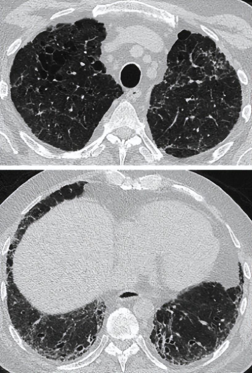 肺纤维化合并肺气肿患者hrct成像中高,低衰减实质特征的定义肺气质乔