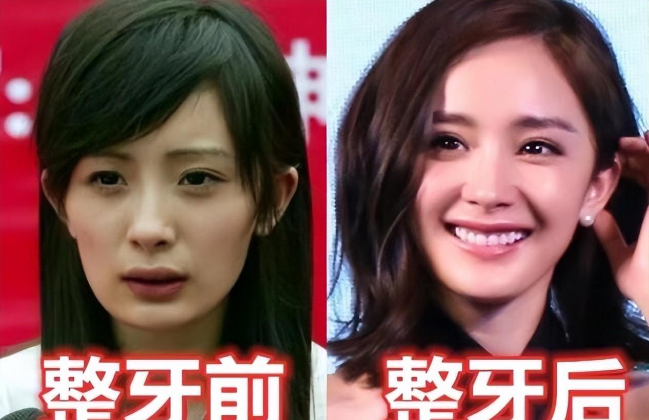 "龅牙,嘴突"对颜值的影响有多大?