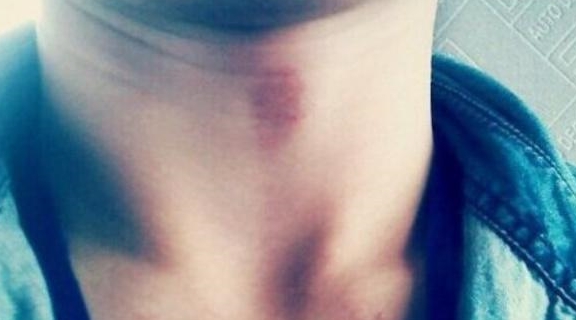 吻痕照片 来自搜狐网