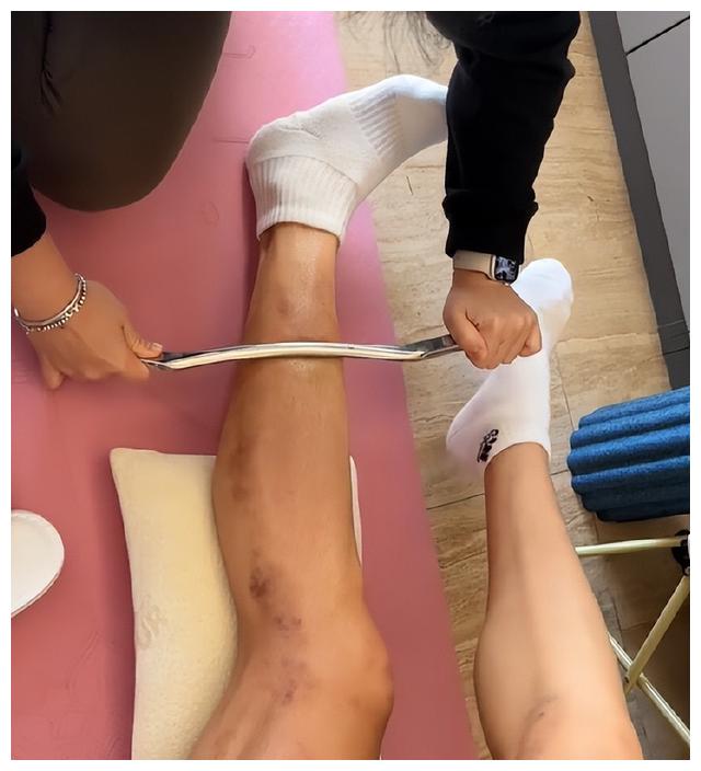 劉晏含做康復治療,大腿傷痕累累,觸目驚心,運動員真不容易_中國女排