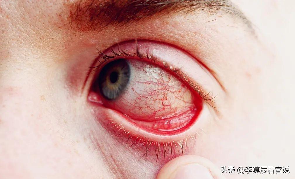 想哭只能忍着,5岁萌娃对眼泪过敏,医生坦言:医学上没这种说法_症状