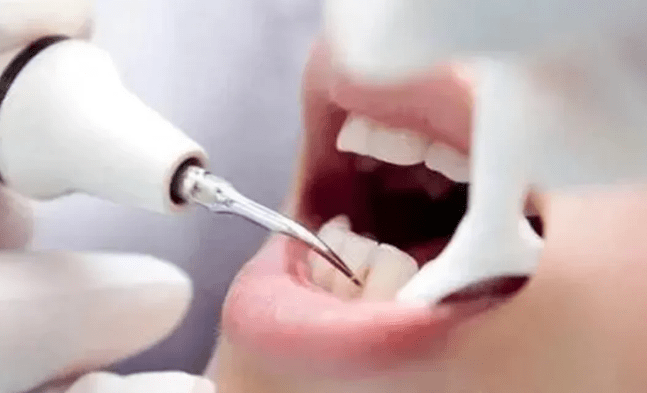 女子因洁牙感染梅毒?口腔机构回应可能性非常低,你怎么看？