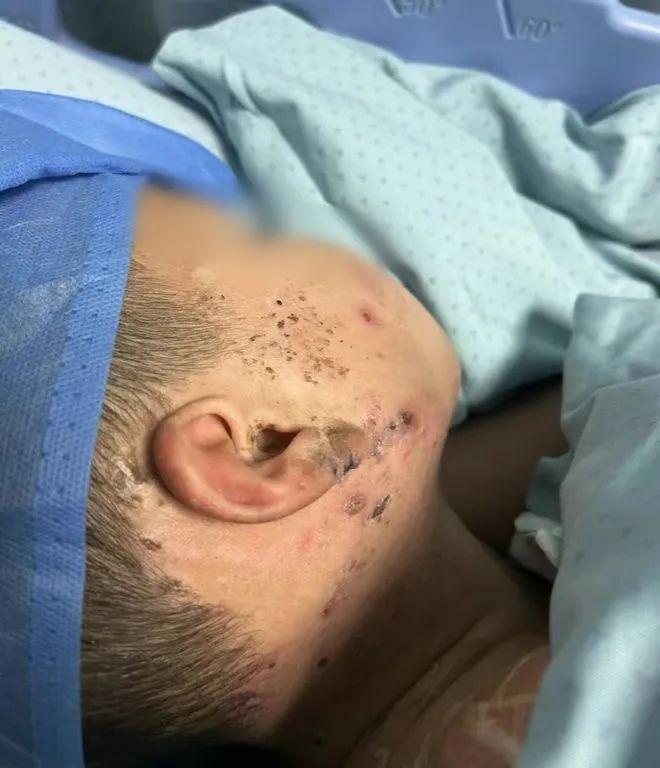 原创             爆炸的炮仗:致江西男童手臂截肢,其家属称涉事邻居