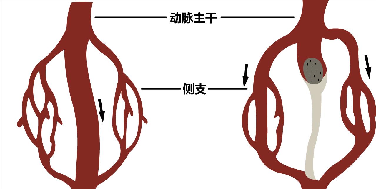的逐渐下降,左侧冠状动脉的逆流现象会日益明显,即使有侧支循环的存在