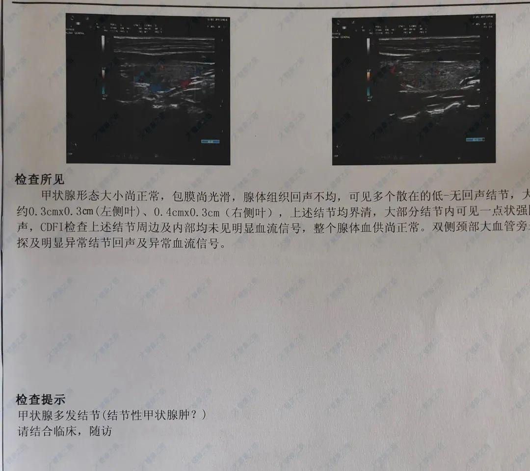 今天就由小薇管家就来教大家看懂"甲状腺b超报告单"吧~许多人在拿到