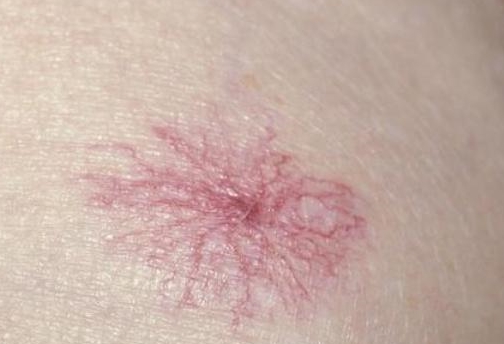 若身体出现这4种"痣"可能是"细胞病变"的信号,早看早受益!