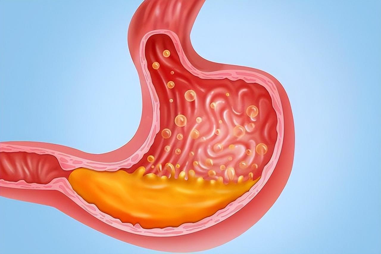 每一个人的胃病情况又不一样,比较常见的胃部疾病有慢性胃炎,胃溃疡