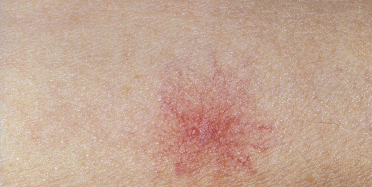 肝癌早期不止是肝疼,皮肤上若有4个表现,或是肝发出的求救信号