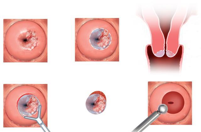 宫颈表面发黑图片图片