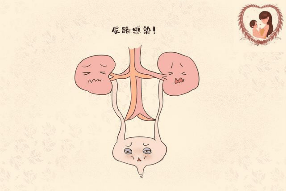 一旦進入2型糖尿病前期,尿路感染是通常發生在膀胱或尿道的泌尿系統