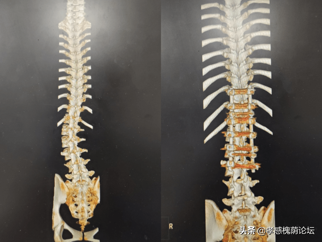 5小时脊柱侧弯矫正术,18岁"驼背"女孩挺直胸膛_小周_手术_胡均