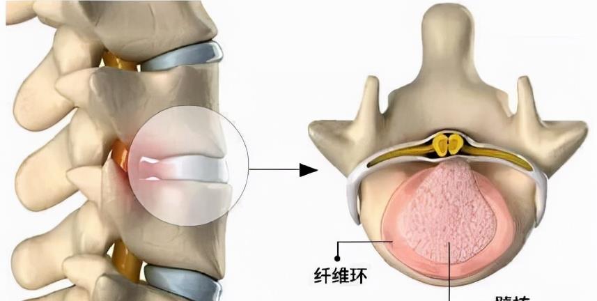 椎间孔和椎管的区别图片