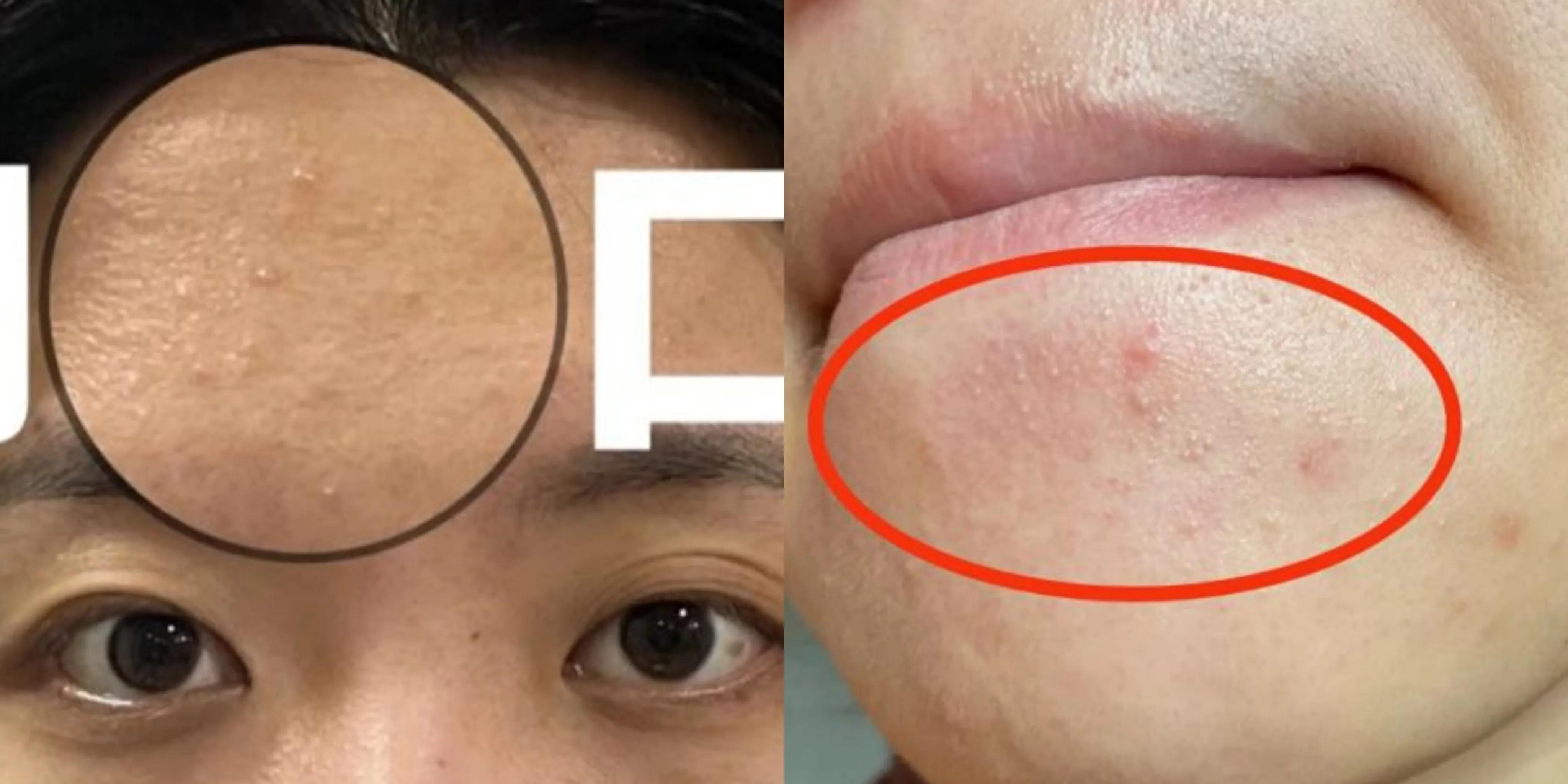 让你难看还爆痘的黑头,闭口,粉刺,到底是什么呢_姐妹_皮肤_毛孔