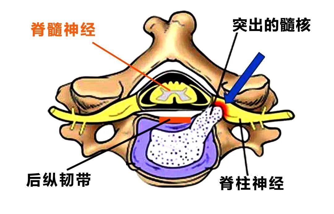 由于颈椎退变导致椎间盘突出,骨赘增生,后纵韧带肥厚等压迫脊髓或压迫