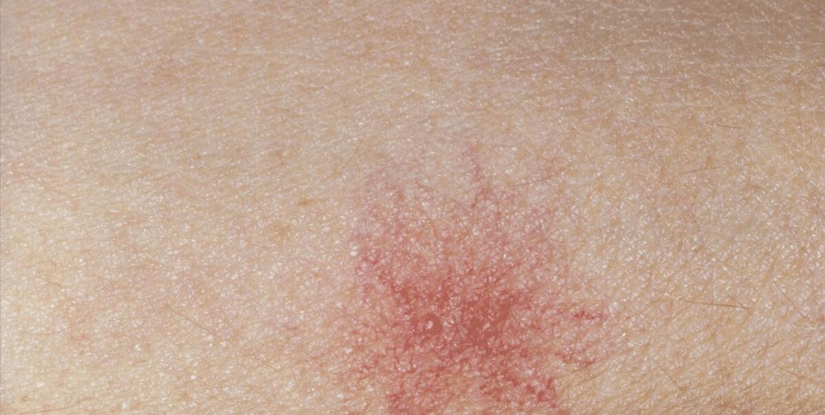 血液中雌激素代谢出现障碍,含量升高刺激皮下毛细血管出现扩张现象