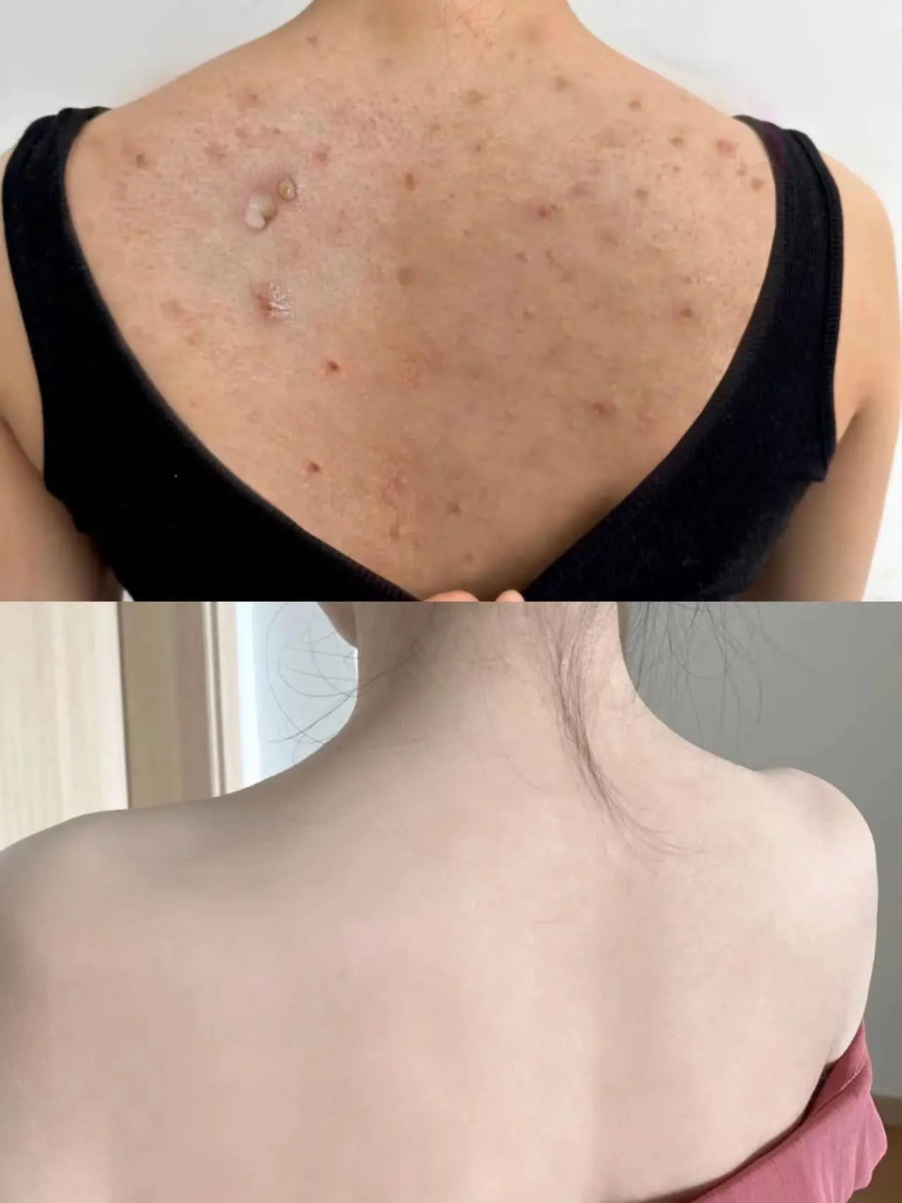 3招消除后背痘,夏日美背小心机!_皮肤_长痘痘_效果