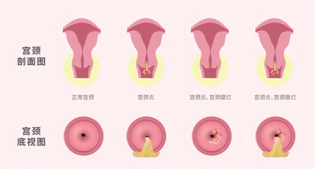 宫颈管炎图片图片
