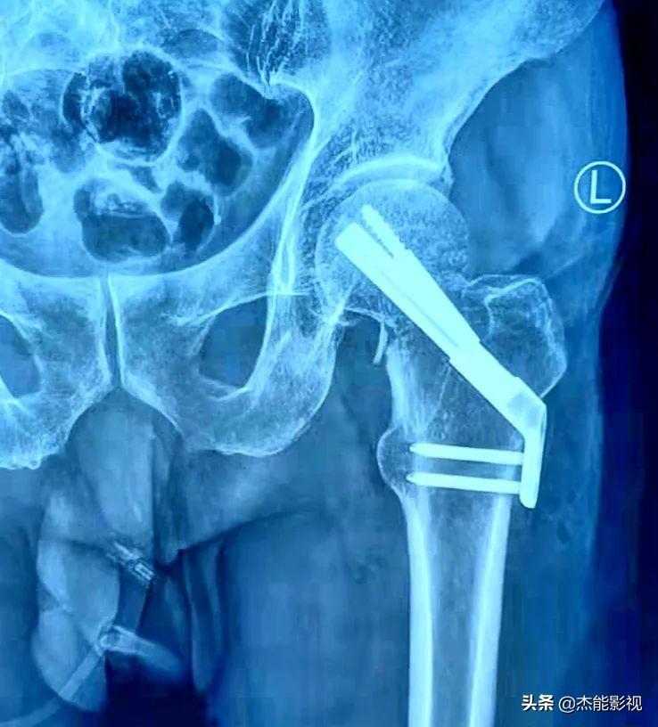 「甘肃」静宁县中院首次成功开展使用fns微创手术治疗股骨颈骨折