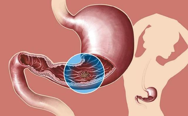 医生告诫:这几种症状不是胃痛,而是胃出血!_时候_十二指肠_食物残渣