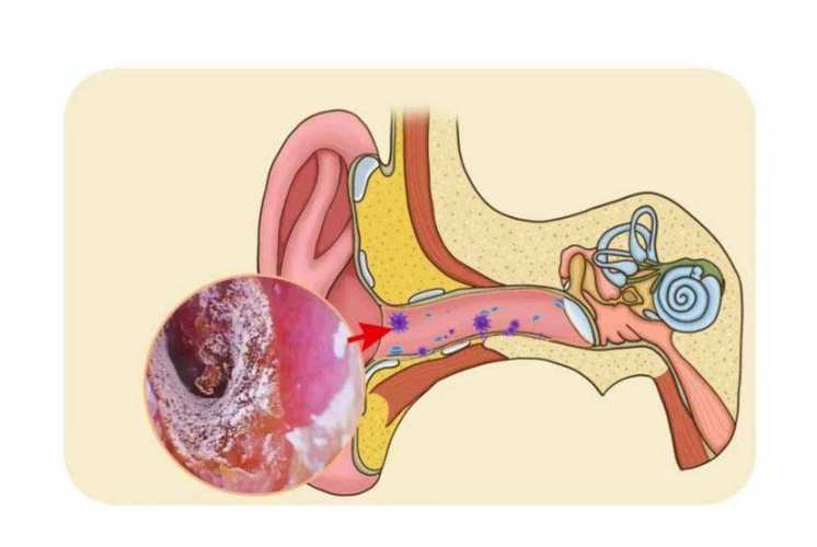 耳朵裡面經常癢,卻啥也掏不出來?