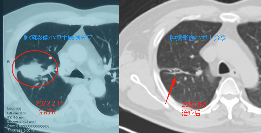 幸运儿：2年前胸部CT正常，发现即4cm局部晚期肺癌，疗效显著_手机搜狐网