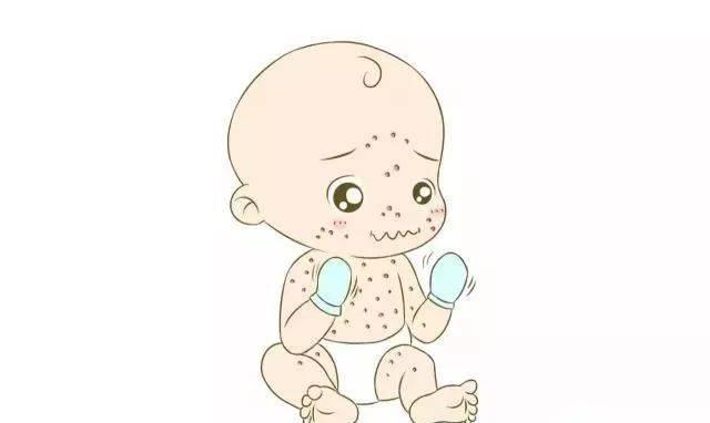 在痂皮尚未形成前,都是水痘的传染期_消息_太太_皮肤