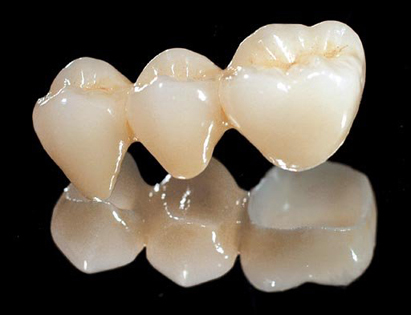 国产的全瓷牙与进口的差距大吗?临平口腔医院梁涛医生怎么样?