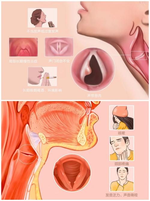嗓子结节图片