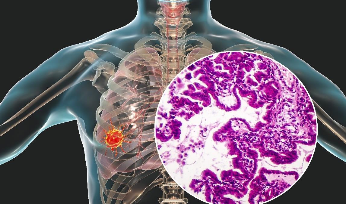 白茫茫!肺部感染最怕三个征兆"思路总结"-第2张图片-乔巴博客