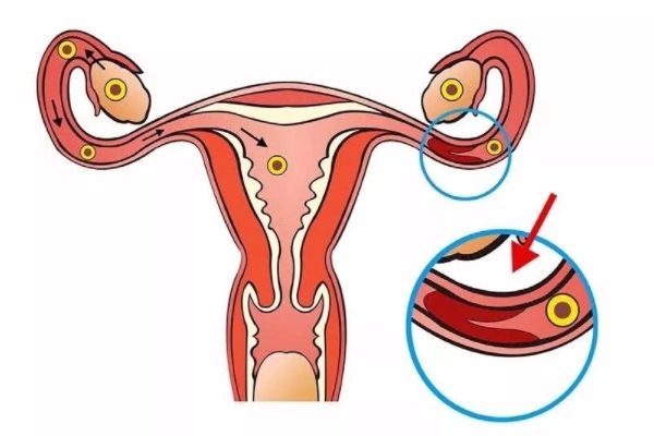 输卵管积水如何治疗(附5个方法)