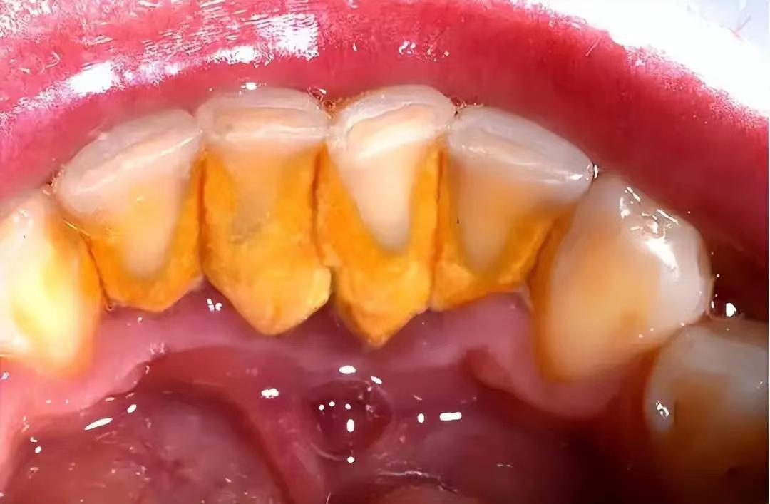 牙结石患者快冲!过来人无偿分享的去石秘籍,效果碾压洗牙处理!