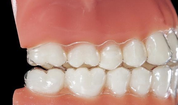 现在牙套的种类有多少种,哪个好_矫治_牙齿_问题