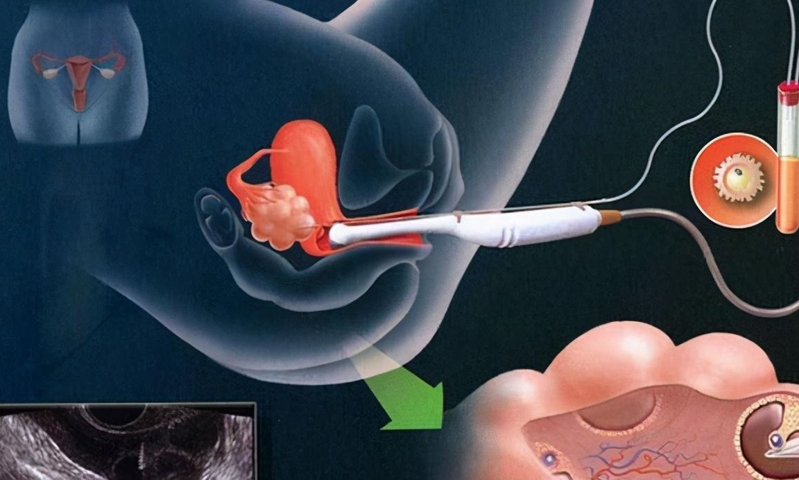 来听听!人工授精顺利着床表现"万事顺意"-第1张图片-思度网