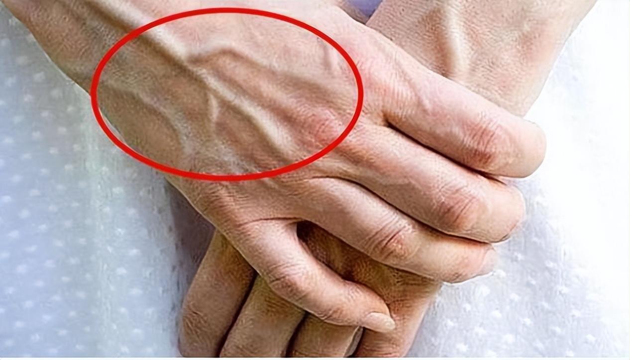 青筋主要是指手臂和手部的静脉血管网,人体的血管主要分为动脉