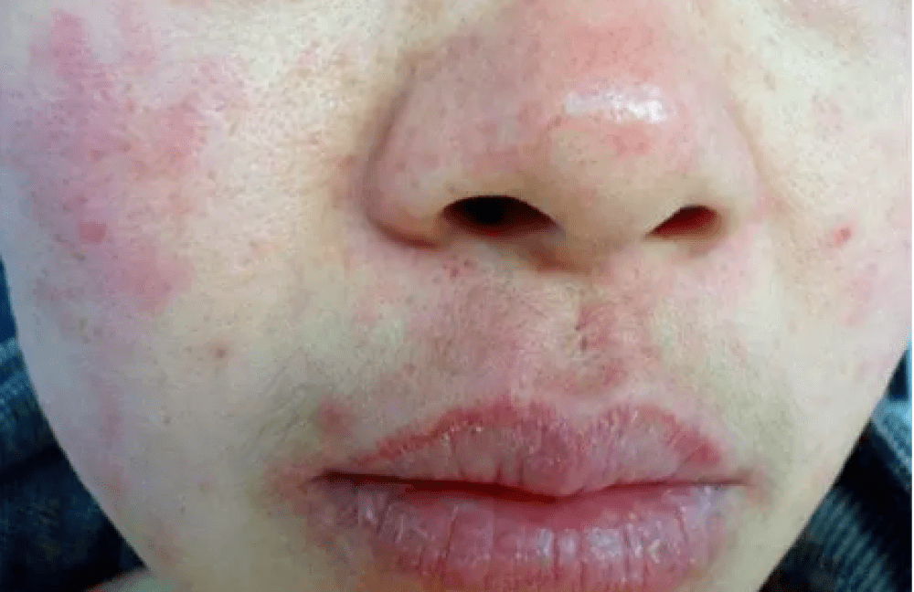 长沙皮肤病科普—皮肤过敏脱屑是什么原因导致的!