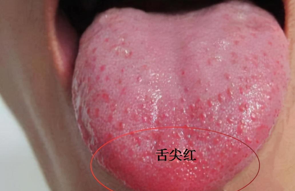 舌尖红心火旺,舌边红肝火旺,舌全红胃火旺,送你简单应对方法_蒲公英