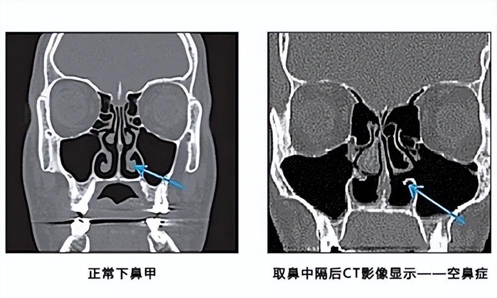 郑重提醒:千万不要随便动鼻中隔,进行隆鼻!_鼻头_手术_时尚