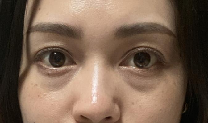 到底用什么方法祛眼袋效果好?_皮肤_脂肪_类型