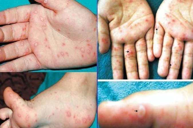 "手足口病"又到高发期 学会预防最关键_孩子_病毒_污染