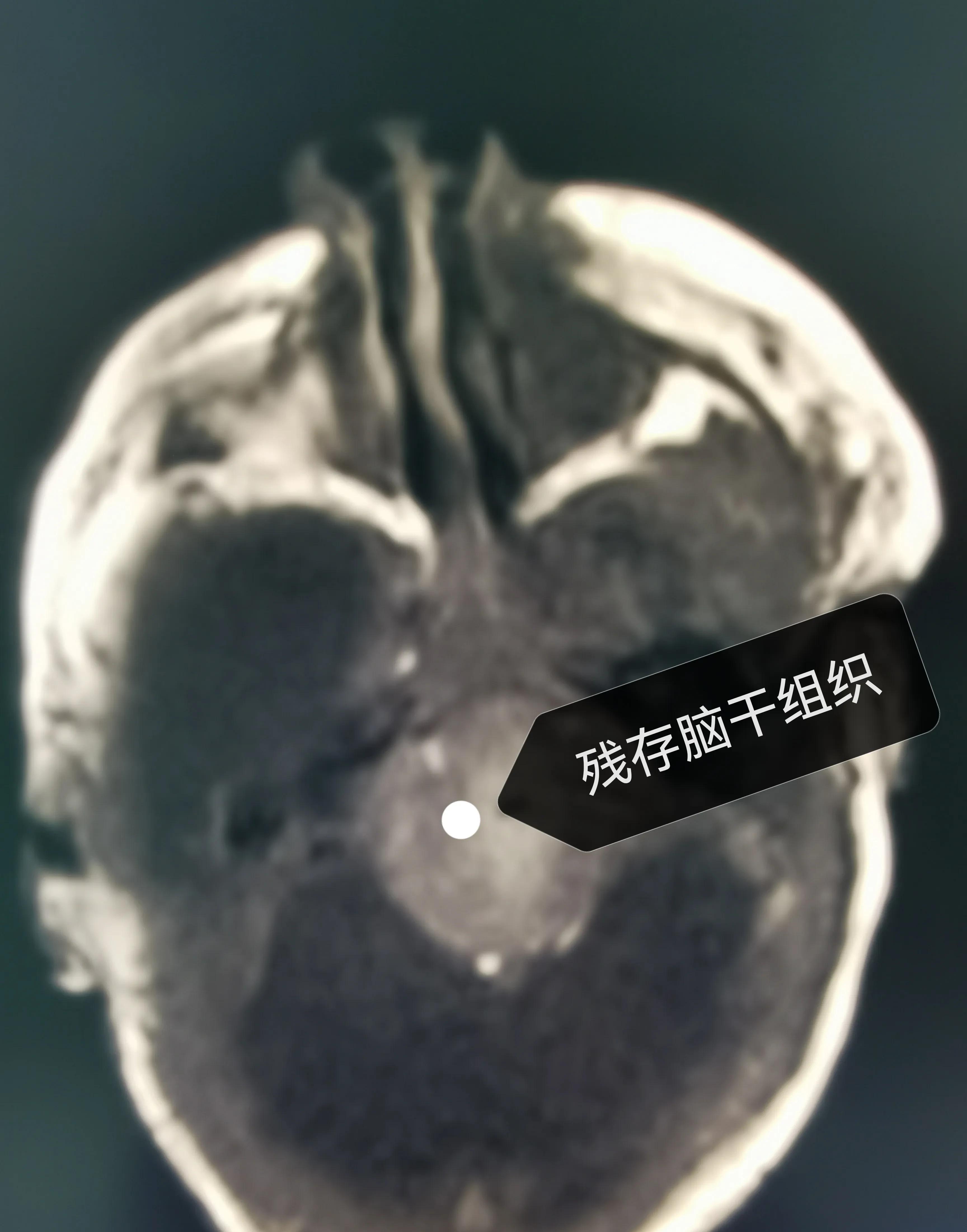 产检的新的性:一例积水型无脑畸形患儿