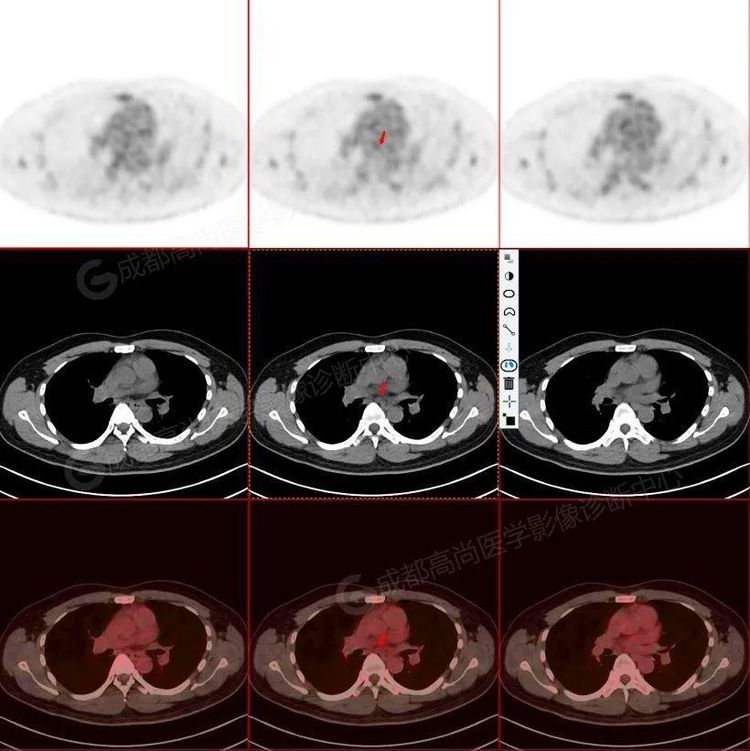 惰性b细胞淋巴瘤pet/ct诊断及疗效评估1例_检查_病变_淋巴结