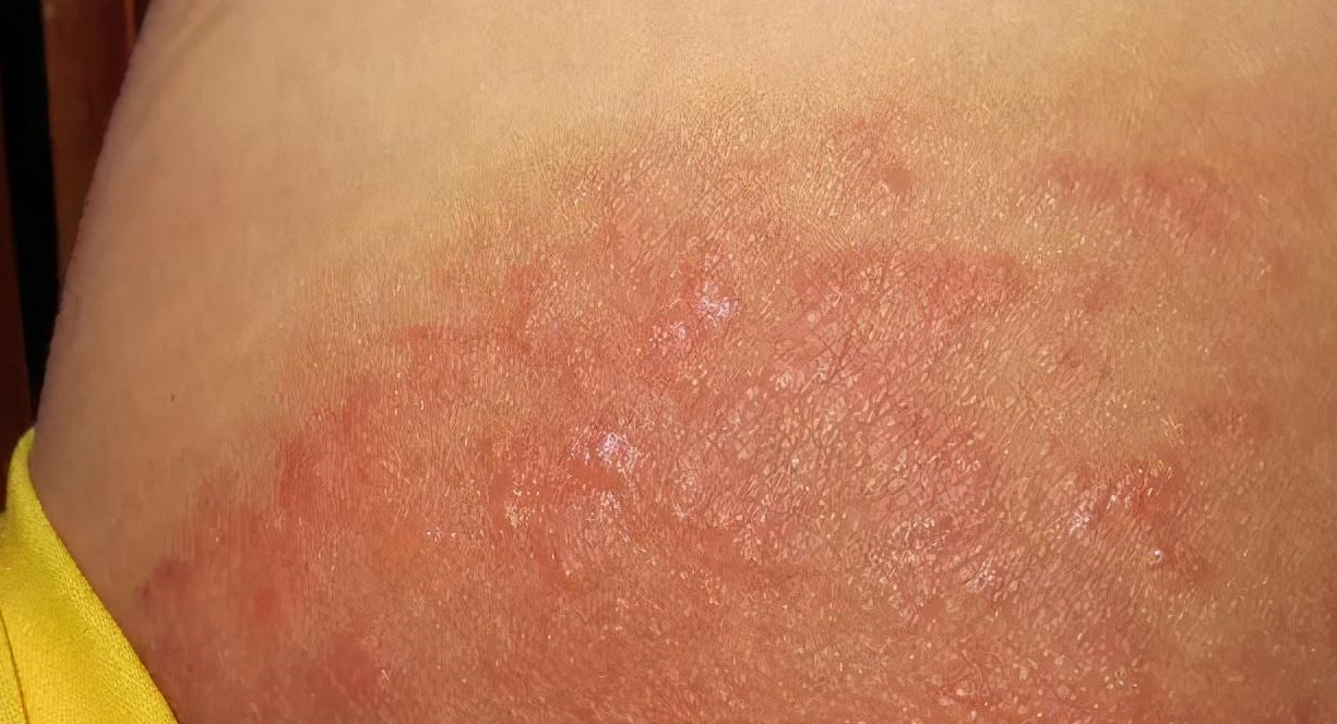 以为是皮肤病去体检,才发现原来自己感染了梅毒,目前已经在第二期